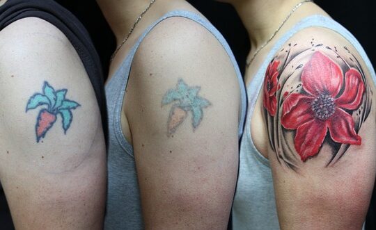 tattoo weglaseren